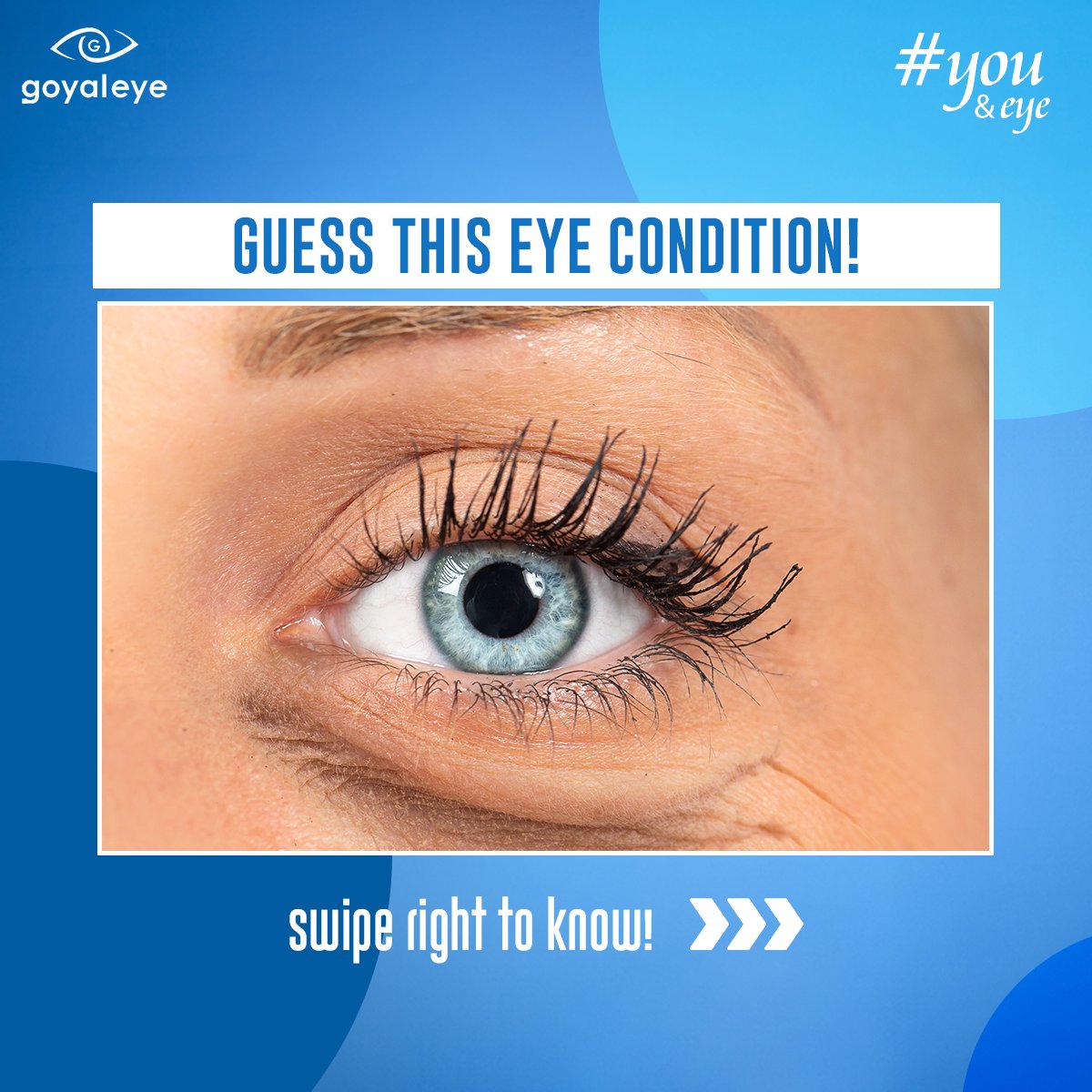 goyaleye's tweet image. Can you guess the condition affecting these gorgeous eyes?

Aging, lifestyle, or genetics—whatever the cause, our eyes deserve to radiate beauty. 

#GoyalEye #YouAndEye #EyeCondition #SaggyEyes #EyeIssues