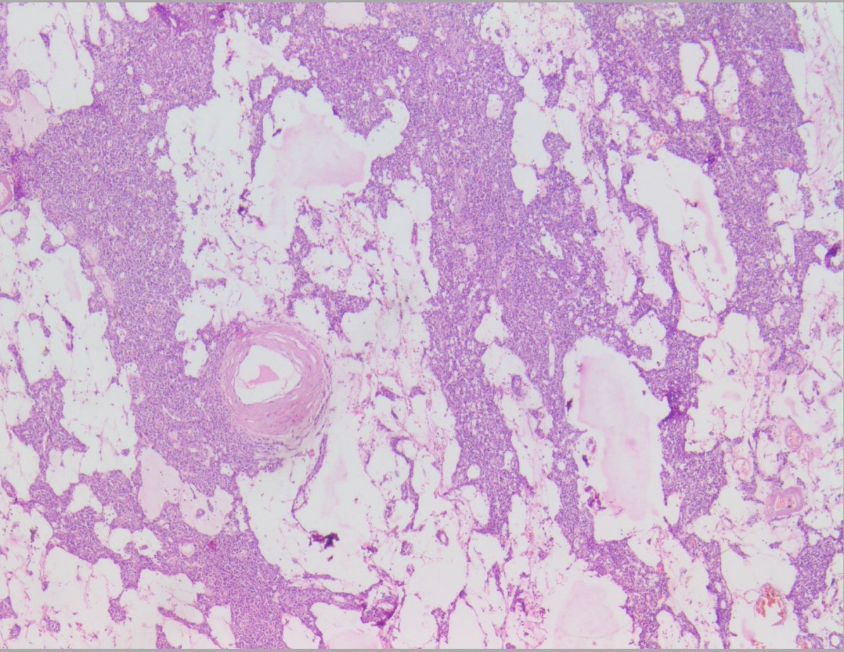 #surgicalmeet
47/M : Exophytic 4 cm reddish mass in left kidney (interpolar region)

🔬1 : HellaLPPath

More images follow👇🏻

#GUPath #pathX #pathTwitter #pathology #pathoutpic