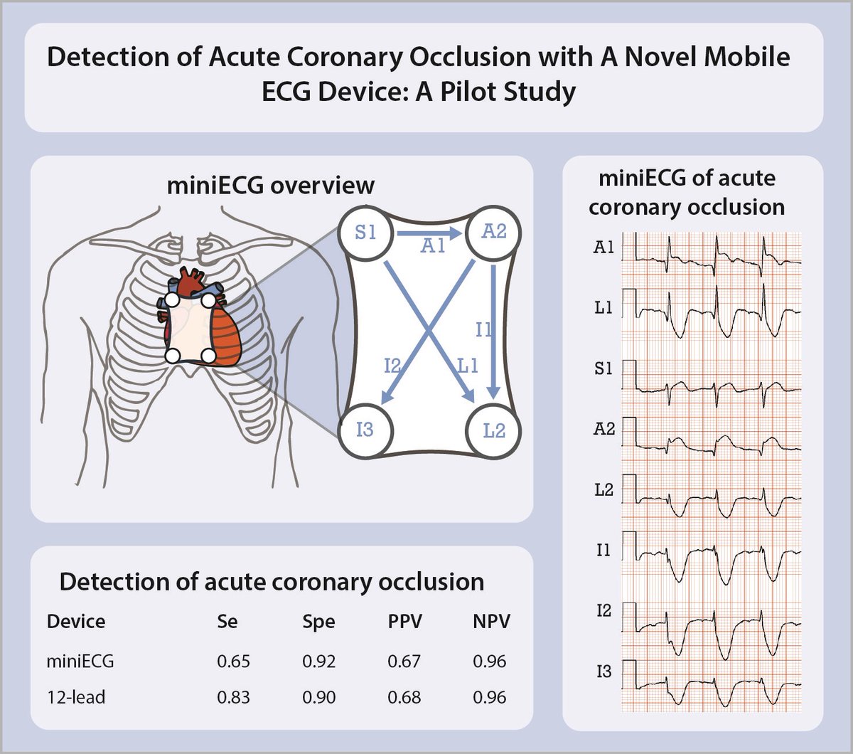 European Society of Cardiology Journals (@esc_journals) on Twitter photo Detection of acute coronary occlusion with a novel mobile ECG device: A pilot study bit.ly/3HsMyjr
#EHJDigital #mHealth <a href="/BruiningNico/">Nico Bruining EiC EHJ Digital Health</a> <a href="/rafavidalperez/">rafavidalperez</a> <a href="/GerdHindricks/">Gerhard Hindricks</a> <a href="/rbcasado/">Ruben Casado Arroyo</a> Detection of acute coronary occlusion with a novel mobile ECG device: A pilot study bit.ly/3HsMyjr
#EHJDigital #mHealth <a href="/BruiningNico/">Nico Bruining EiC EHJ Digital Health</a> <a href="/rafavidalperez/">rafavidalperez</a> <a href="/GerdHindricks/">Gerhard Hindricks</a> <a href="/rbcasado/">Ruben Casado Arroyo</a>