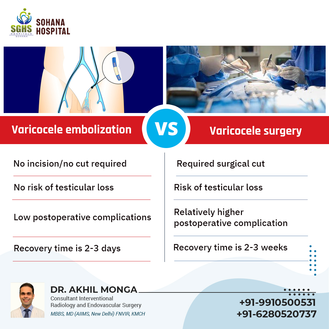 Discover choices for Varicocele treatment - surgical or embolization. Advancements offer alternatives beyond surgery. Learn the difference between methods for informed decisions. bit.ly/3X0x64x #Varicocele #scrotumveinenlargement #Varicoceletreatment