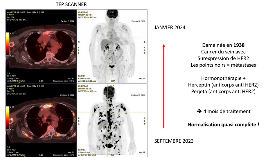 barriere_dr's tweet photo. Permettez ici que je vous illustre la joie du cancérologue ! 😌
Quand il prend connaissance des résultats d’un TEP scanner d’une dame de 85 ans qui était vraiment mal en point en septembre… et qui aujourd’hui est en pleine forme !
C’est aussi ça les fantastiques avancées ! https://t.co/7WkuTZsja8