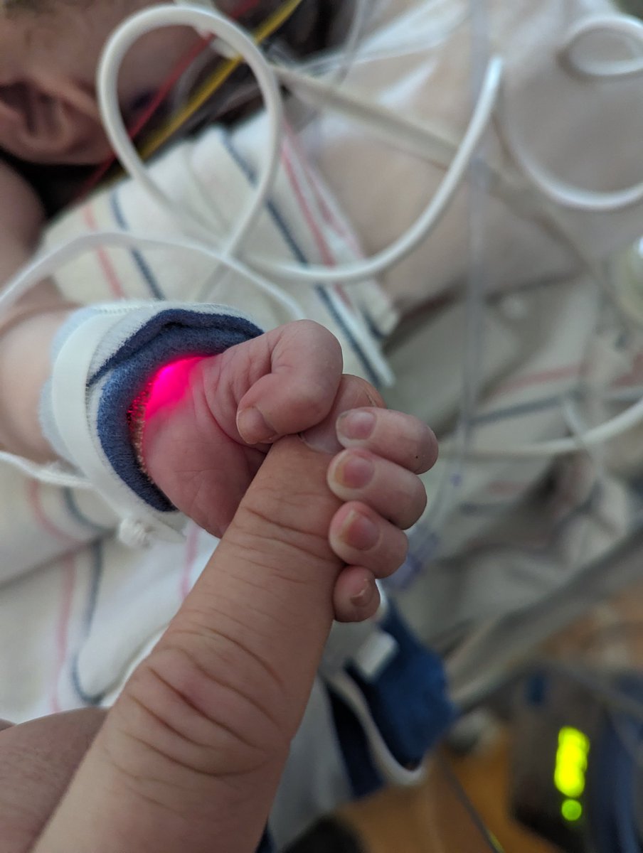 mark_joubert's tweet photo. Gus had a stable night. He shed a lot of fluid overnight (kidneys doing well!) so he looks better. His nurses &amp; doctors are impressed with his progress. His new heart continues to beat -- not yet a full, self-sufficient beat, but it's holding strong. God is so kind. Keep praying! https://t.co/uU7qroCLds