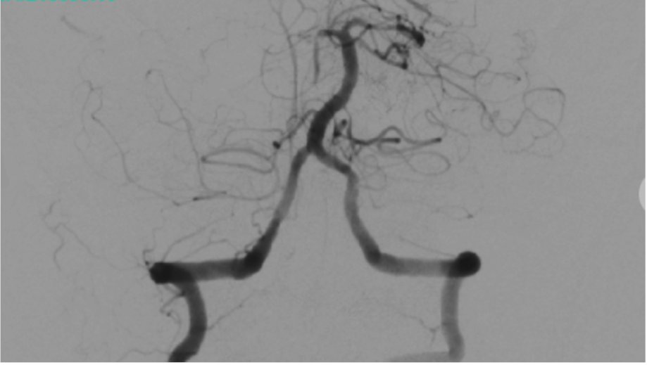 PenNeuro's tweet photo. US HCPS: Check out this great TICI 3 result in the PCA using RED 43 with radial assistance from BMK71! Thank you to Dr. Amir Khan for sharing! 

Rx only. For risk info: https://t.co/BeLdB4YK3z Clinical results may vary. https://t.co/14b0cwL6Sy