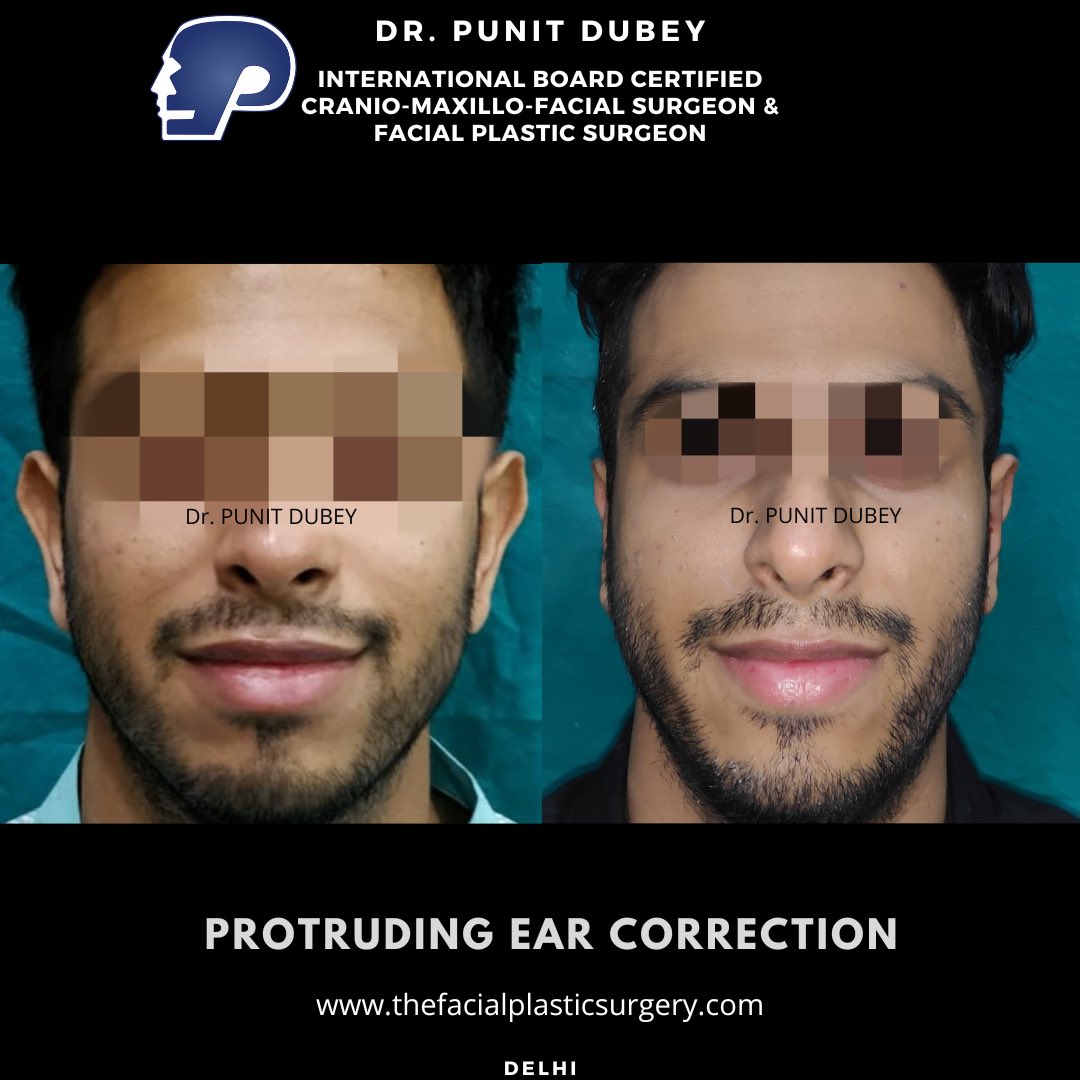 DrPunitDubey's tweet photo. Prominent Ear Correction under local anesthesia.👂

It involves correction of shape of ear in an adult and children.

Learn more about it.

#protrudingearcorrectiondelhi #otoplastydelhi #earsurgerydelhi #prominentearcorrectiondelhi #drpunitdubey https://t.co/bpy0Gd1A9z