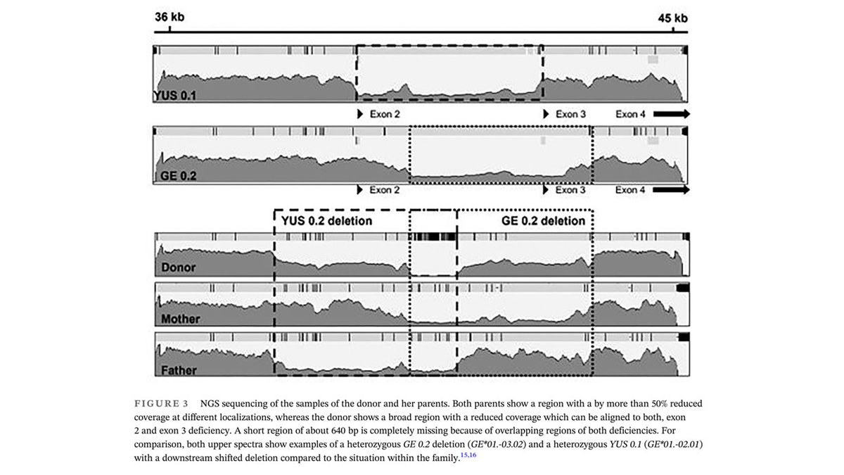 Compound heterozygosity for GYPC exon 2 (GE*01.-02) and exon 3 (GE*01.-03) in the donor and her sister. Anti-Ge2 antibody present (probably naturally occuring). tinyurl.com/5a26su4z #blood_groups