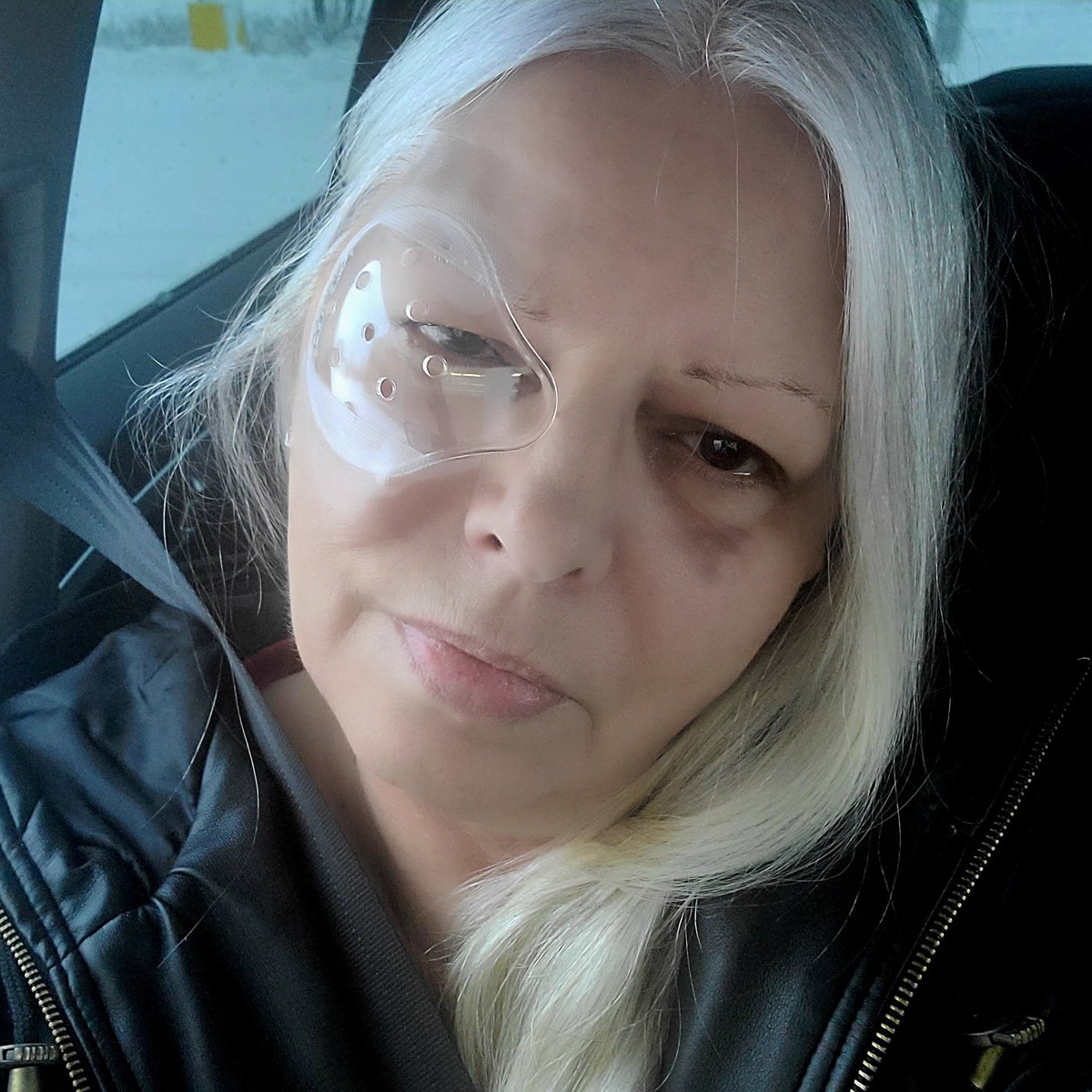 SueOestmann's tweet image. Pic from just after surgery, one week ago. Last night with eye patch. 2nd eye surgery next Friday. I&apos;ve been wearing sunglasses. Light sensitivity is rough. #FaceYourFears #LensReplacement #EyeHealth #CataractSurgery #MacularDegeneration #ConvergenceInsufficiency