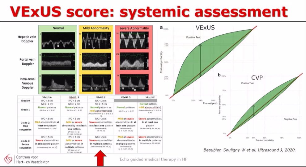 iamritu's tweet photo. When LVOT VTI(CO) is normal to high, and patient has hypotension or worsening renal function don’t just push more fluids- check VExUS score (better prognostically than CVP) 
#3DEchoBerlin #echofirst https://t.co/3FbVLKA6iX