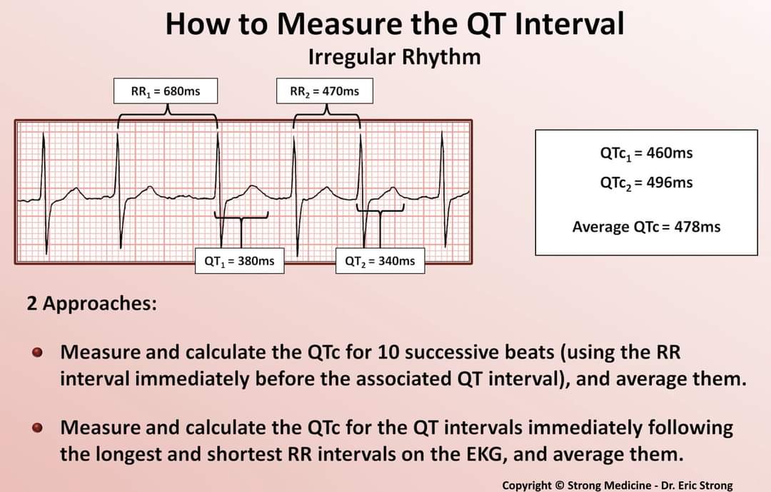 ZHeart11768530's tweet image. How to Measure QT Interval and Calculate the QTc : Thread 1/4

Copyright @Strong Medicine Dr.Eric Strong 
#CardioTwitter #cardiology 
#cardioEd #QT #QTc #Interval #Measurement #UWave #cardiology #diagnosis #ecg #ekg #electrocardiogram