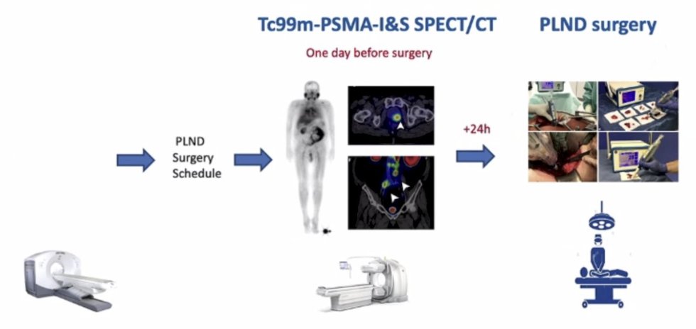 Clinical impact of PSMA PET prior to prostatectomy. Great presentation from @RobertReiterMD @UclaUrology. Written coverage by @zklaassen_md @GACancerCenter on UroToday > bit.ly/4belyBY @PSMAconference @UCLAJCCC @UCSFCancer @PCFnews #2024PSMAConference