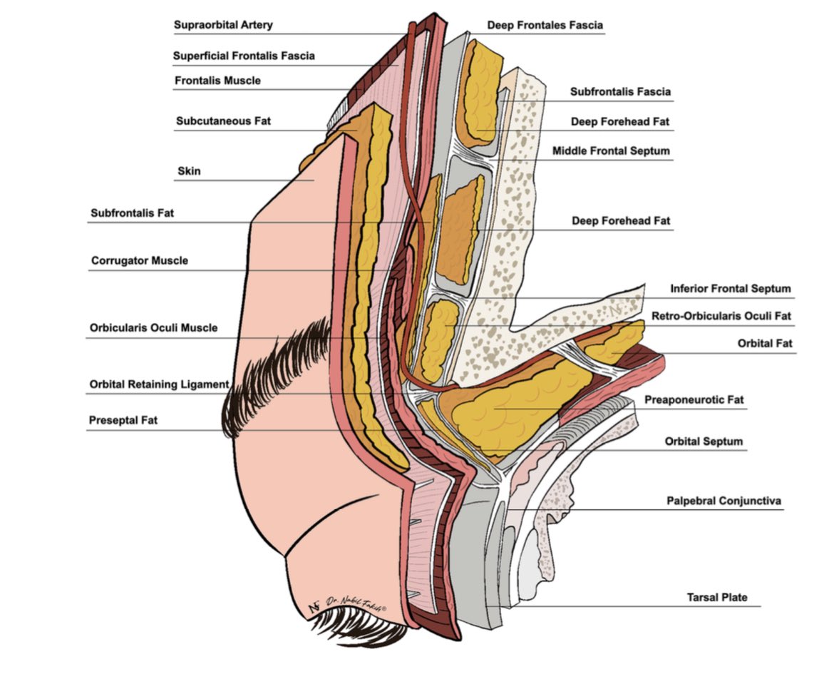 Refined technique for non-surgical correction of sunken eyes and simplified treatment-oriented classification

From the Netherlands 🇳🇱 and Lebanon 🇱🇧

link.springer.com/article/10.100…