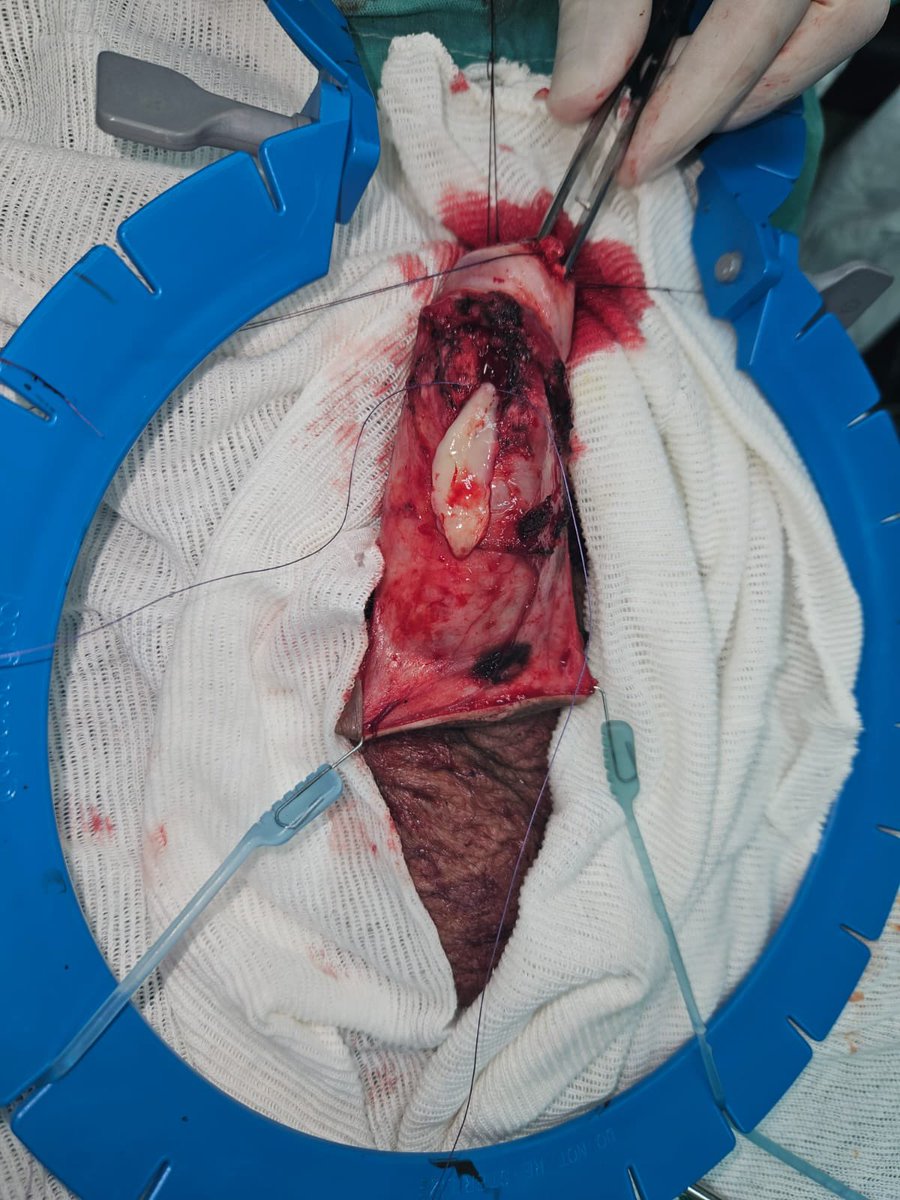 MauroMMeo's tweet photo. Paciente de 47 años con diagnóstico de liquen esclerosis genital. Se realizó plástica de meato uretral y fosa navicular con injerto de mucosa yugal con técnica de preservación glandelar.

Dorsal onlay BMG technique with subcoronal approach and glans preservation.

#CCU https://t.co/6IcL4W6rNH