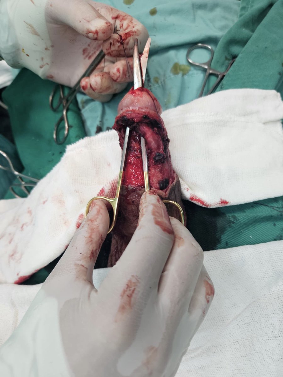 MauroMMeo's tweet photo. Paciente de 47 años con diagnóstico de liquen esclerosis genital. Se realizó plástica de meato uretral y fosa navicular con injerto de mucosa yugal con técnica de preservación glandelar.

Dorsal onlay BMG technique with subcoronal approach and glans preservation.

#CCU https://t.co/6IcL4W6rNH