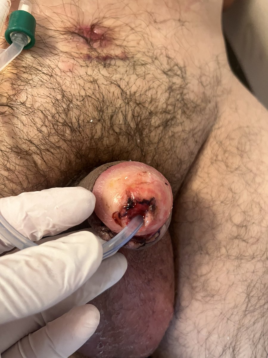 MauroMMeo's tweet photo. Paciente de 47 años con diagnóstico de liquen esclerosis genital. Se realizó plástica de meato uretral y fosa navicular con injerto de mucosa yugal con técnica de preservación glandelar.

Dorsal onlay BMG technique with subcoronal approach and glans preservation.

#CCU https://t.co/6IcL4W6rNH