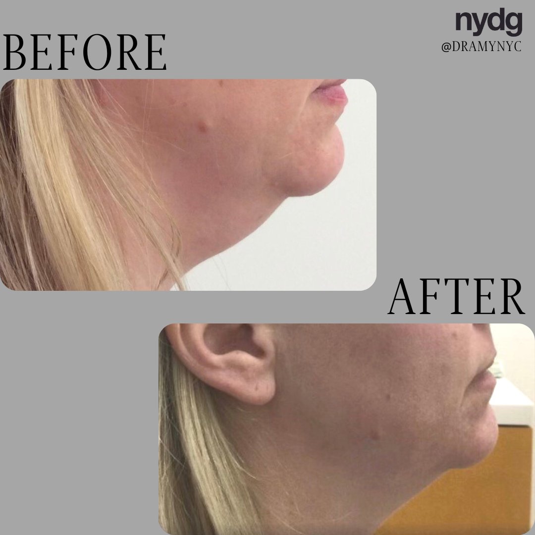 NYDermGroup's tweet photo. Before &amp; After: 1 treatment of Submental CoolSculpting ⁠with Dr. Amy Perlmutter - this patient had great results and now has a more contoured, defined, and youthful appearance! ⁠ https://t.co/k1WVtcZGlg
