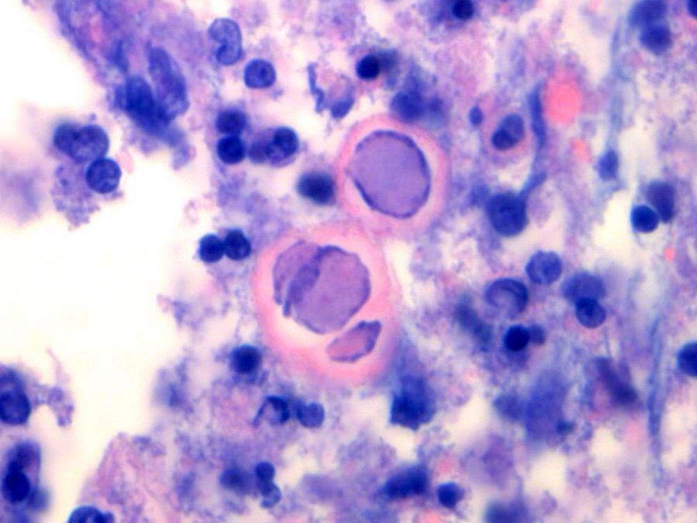 Our favorite Directory image of the week is from Curtis R. Strong, M.D. 
Subspecialty: Pulmonary / thoracic
Diagnosis: COVID-19 pneumonia in a bronchoalveolar lavage 
Dr. Strong's profile: buff.ly/492C3ij 

#directory #image #thoracic #pathology #PathTwitter #COVID19