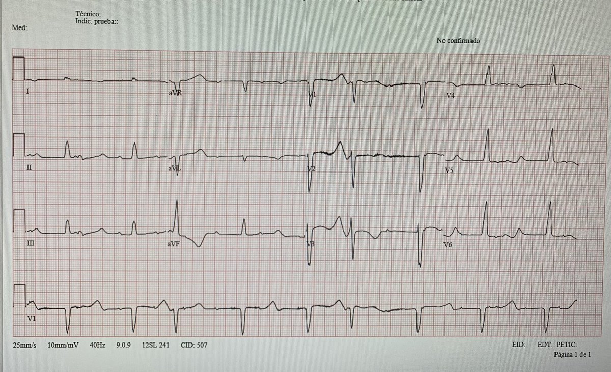 89 y/o 👨🏼‍🦳 Respiratory infection. Presyncope. Admitted to the ER. Interesting #ECG performed at that time. 🔎🔎Thoughts? #CardioTwitter #cardiology #Medstudent #Epeeps