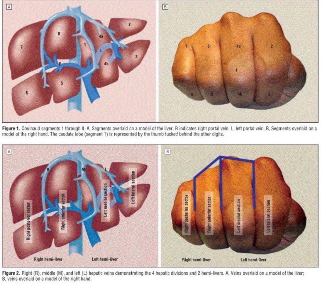 OGdukeneurosurg's tweet photo. Great way to remember liver segments and anatomy from arch surg https://t.co/SfV36JFjr7