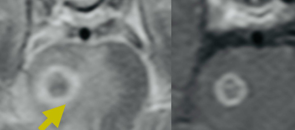 Tip of the day 💡: T2 hypo-intense core with peripheral ring enhancement are hallmarks of tuberculosis- even in this Caucasian child. With population movements, any disease can be found anywhere in the world without stereotypes. Travel with care this weekend.