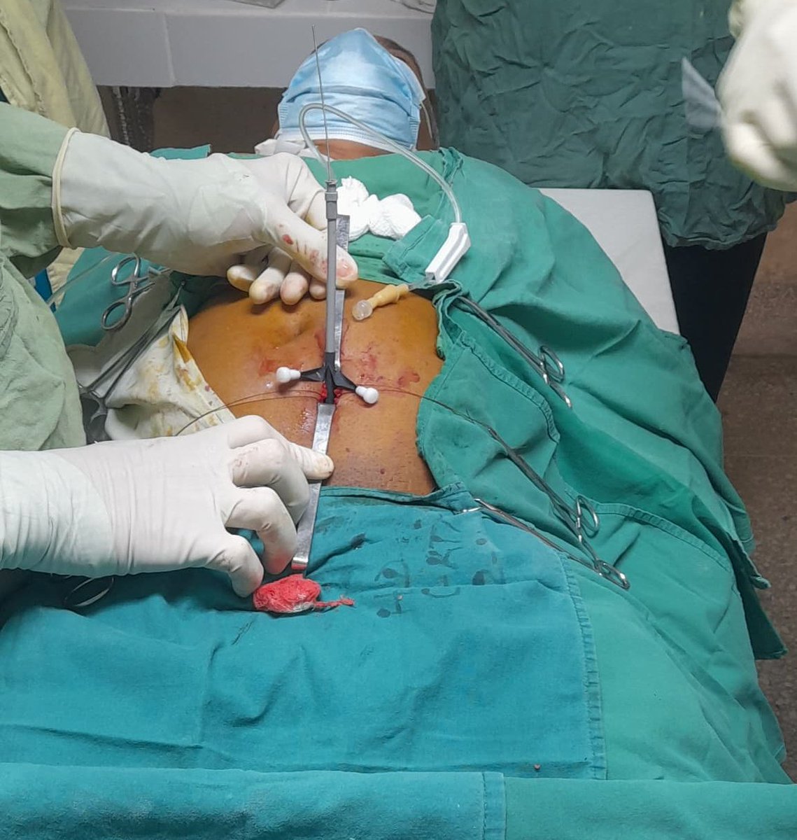 LazaroIbrain's tweet image. Increasing #peritonealdialysis capacities in Cuba thanks to @ISNkidneycare #InterventionalNephrology Scholarship and @ISPD1 Fellowship.

Very proud of my two mentors @bernardo_moguel and @NefChago... thank you for everything!

#pdfirst #ISNyoung