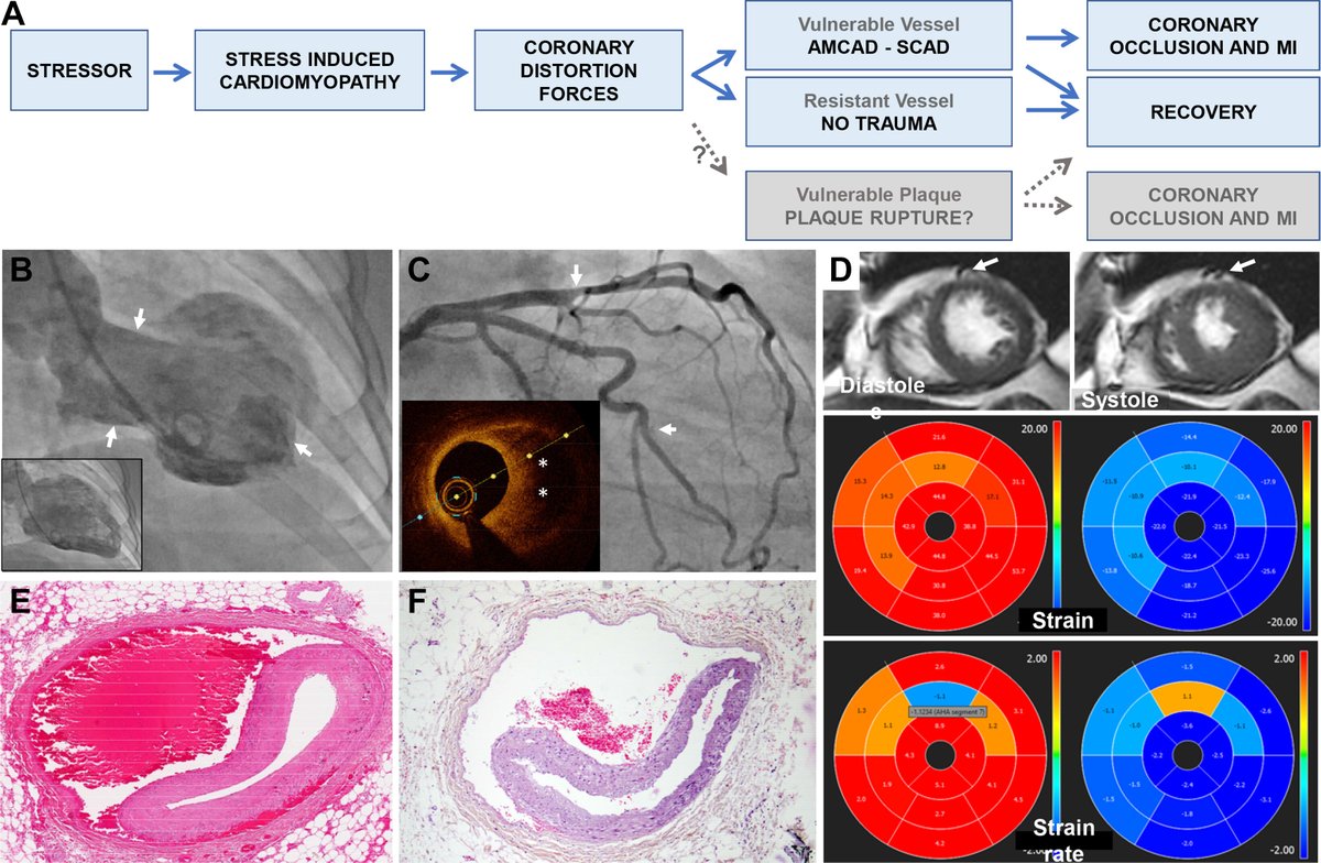 Dr. @rajivxgulati, et al offer a collection of observations that support an alternate hypothesis in many cases—that #SCAD is a secondary event instigated by SICM (Takotsubo and variants). Learn more here: bit.ly/3O9yYoQ #JACCAdvances #cvCAD