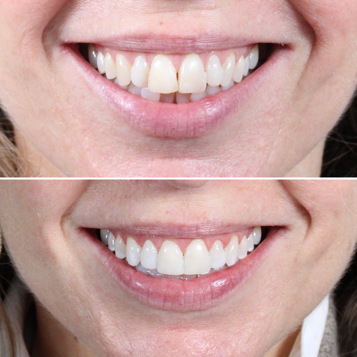 dremmalaing's tweet photo. First case completion of 2024

“In the past week, three people have commented on ‘my perfect smile’ and it’s all thanks to you. As you know I something of a perfectionist, yet your treatment completely exceeded my expectations.” https://t.co/w7e8pg0O5E