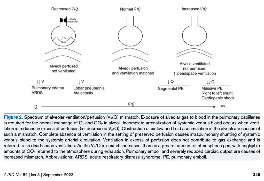 Core Curriculum by Biff Palmer and Deborah Clegg: Respiratory Acidosis and Respiratory Alkalosis: buff.ly/3D2hjcN (FREE)