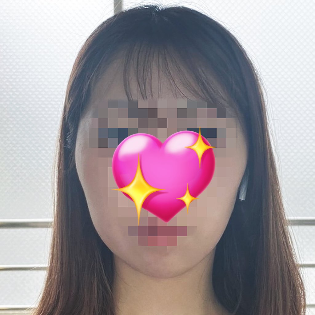 szyoon_2's tweet photo. 私も深堀先生に脂肪吸引してもらったけどフェイスライン本当綺麗になったヨ🥹❤︎❤︎
別人すぎる🤣🤣 https://t.co/l0MPs2i1uU