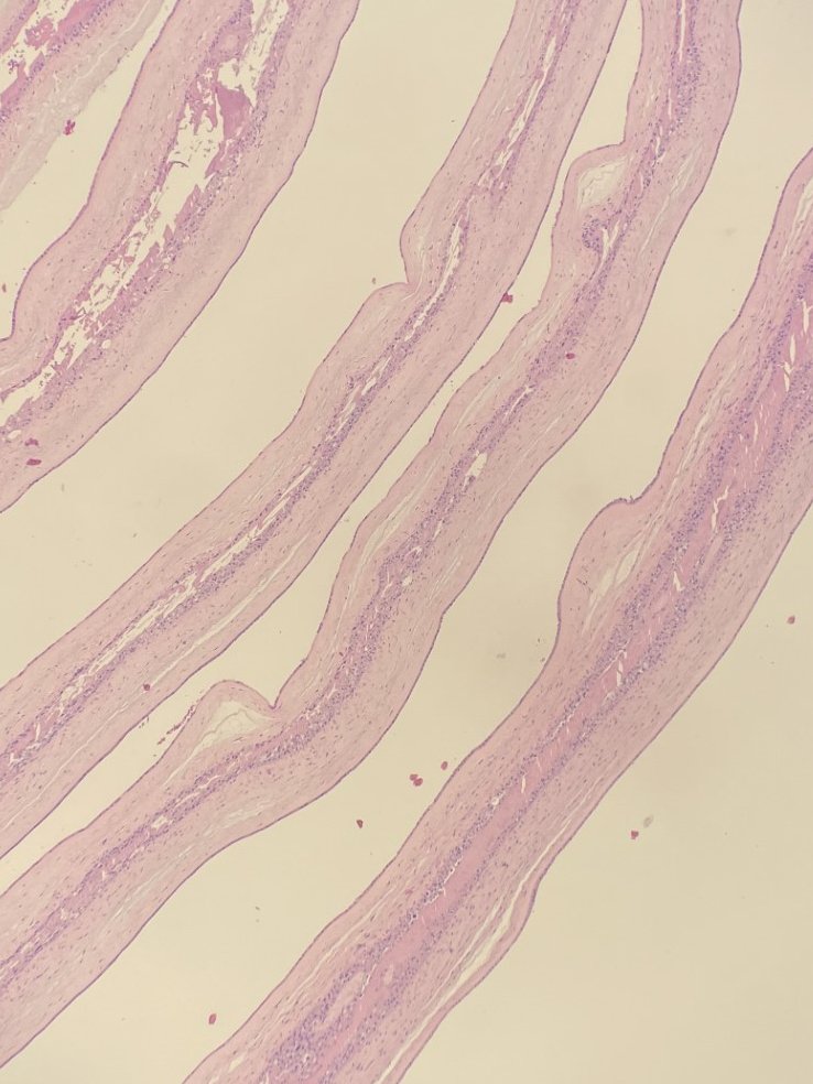 #pathresidents, here's a quick one you might see on boards. Based on this twin placental membrane, what is the amnionicity and chorionicity? Di/di, mono/di, mono/mono?