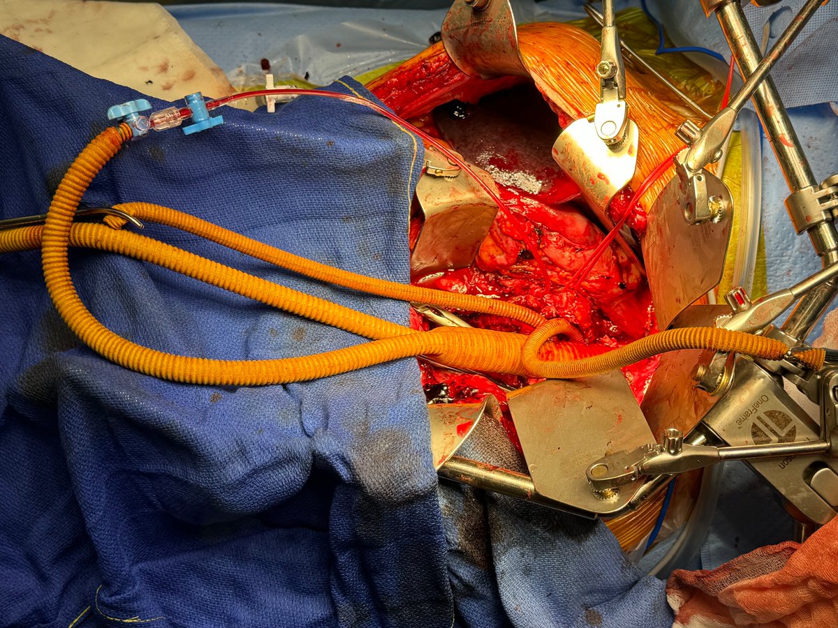 Great team work with 6 open aortic cases this week. Highlight was a type 4 mycotic contained rupture aortic aneurysm. Off pump surgery with clamp and go for thoracic aorta suture then SMA auto shunt from one graft limb by a Pruitt Catheter. #aortaEd