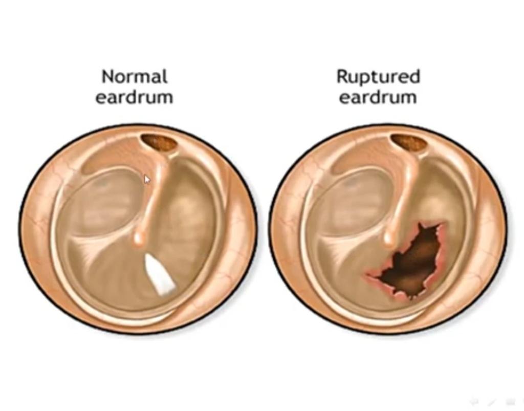 FirstDoctor's tweet photo. 1. Don't put cotton buds in your ears.
2. Your ears cleanse themselves when you chew or yawn. 
3. Using cotton buds can push wax back into your ear and rupture your eardrum.
4. And let me make this clear to you:
EAR WAX IS NOT DIRT!
5. Ear wax actually keeps your ear free from tiny insects and dirt because it is acidic and helps prevent fungi from growing in your ear. So removing your wax might actually do more harm than good.
6. Even if you think you have earwax build-up that needs removing, please don't remove it yourself. Let your health provider do it for you.