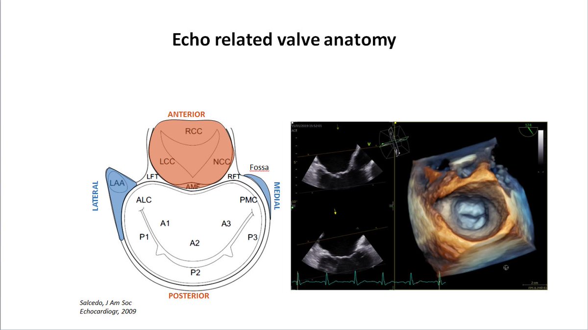 echo_stepbystep's tweet photo. #3DEchoBerlin Tips and Tricks on screening and Guiding of TEER 🗣️ @papadocardio 🇬🇷
3D #echofirst in Heart Failure and Valvular Disease #VHD by @NMerke &amp; @dhzcharite 
@JGrapsa @VDelgadoGarcia @EchoBielefeld @hahn_rt
@fiore_corrado @denisamuraru @lpbadano
@alexsfelixecho https://t.co/ALXQUkPs2g