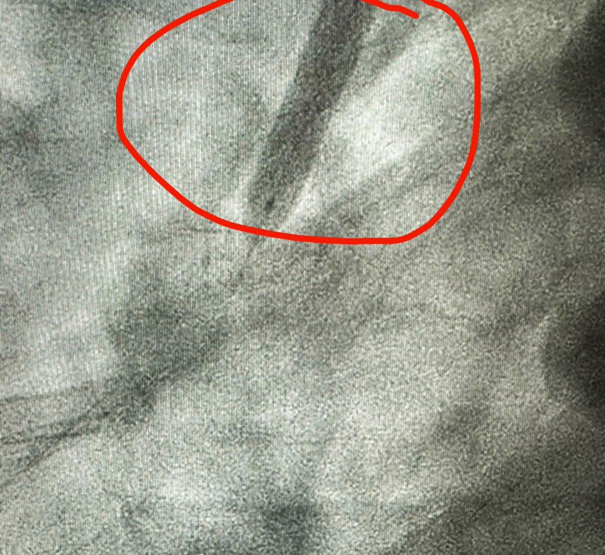 1/2 #StentLoss Acute Inferior MI: complicated by incessant VF⚡️and pt movement. Culprit proximal RCA thrombotic occlusion: with severe diffuse underlying dz. Distal-to-ostial IVUS-guided 👁️ PCI/DES: but…final (short) ostial stent mis-deployed. Recaptured over new balloon🎈and…