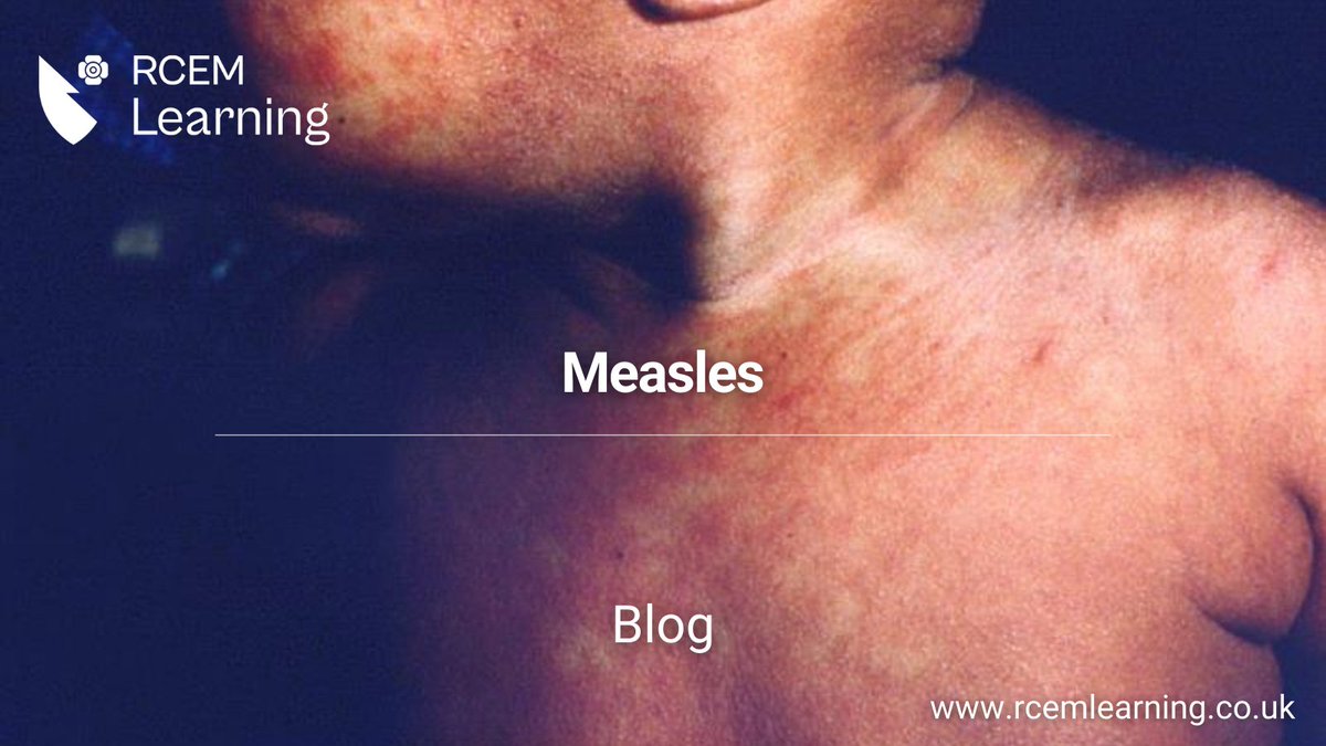 On the 19th January, Dame Jenny has expressed concern that unless urgent action is taken we are likely to see the measles virus spreading rapidly in other areas with low MMR vaccine uptake via <a href="/UKHSA/">UK Health Security Agency</a>

Revise the key symptoms of #measles in our latest blog: rcemlearning.co.uk/foamed/measles/