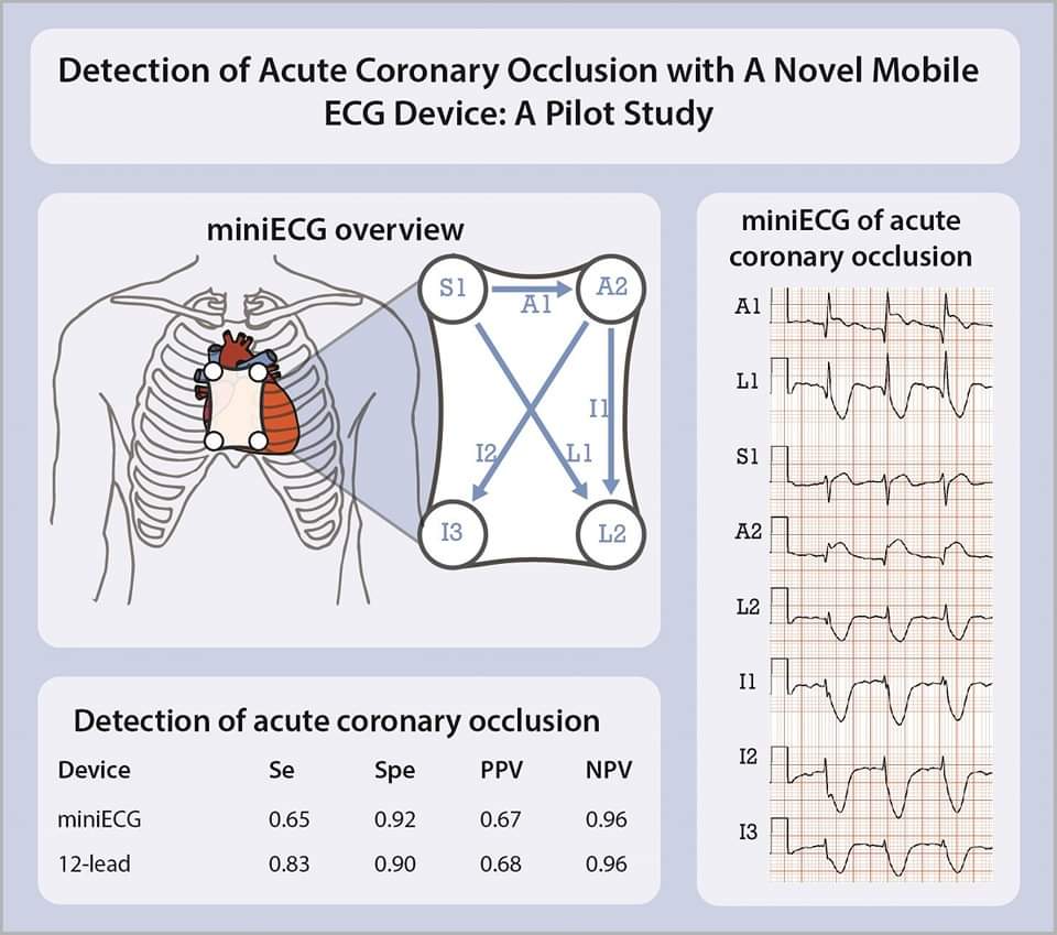 Detection of acute coronary occlusion with a novel mobile ECG device: A pilot study bit.ly/3HsMyjr 

#EHJDigital #mHealth #CardioTwitter #cardiology #CardioEd
