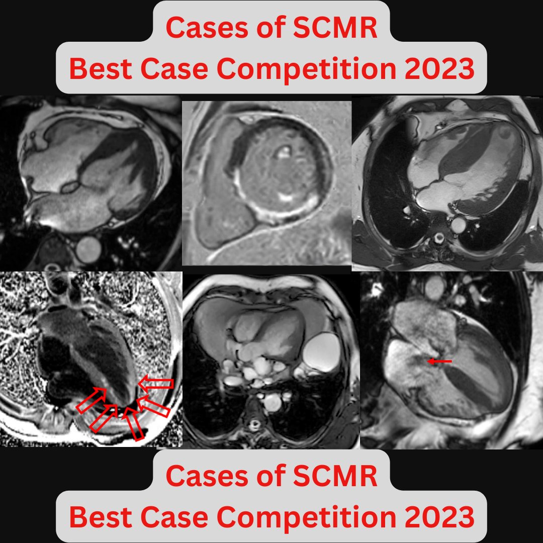 📣Cases of @SCMRorg Best Case of 2023 Competition! 🙏Start #CMR2024 off by attending 6⃣ excellent case presentations from around the 🌎 ✅Thursday 1/25 10:10 AM Gielgud ❔Which is your favorite case? 👇The top 6 cases in no particular order 1/ #SCMRCases