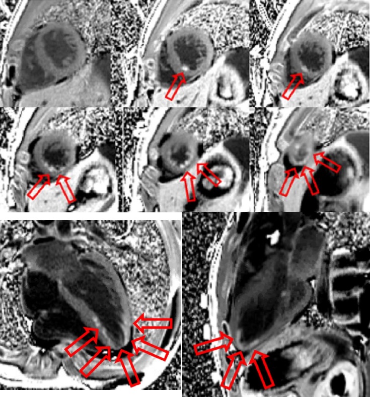 ✅Syncope in teen athlete ✅AAOLCA w/ infarct dx by #WhyCMR ✅FIDDLE → Confirmed subend LGE LV mid/apical inferoseptal & inf walls & apex ✅Normal native T1 & T2 maps ✅No intracardiac thrombus 5/ 👇 scmr.org/page/cases23-01 #SCMRCases @SCMRorg #CMR2024