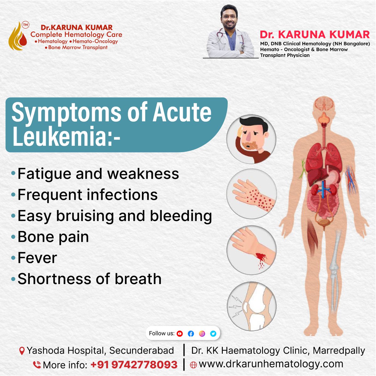 Whispers of acute leukemia: Fatigue's embrace, the dance of infections, and the silent language of bruises. Unveiling the subtle symptoms that speak volumes in the journey.
.
.
#LeukemiaSymptoms #AcuteLeukemiaAwareness #RecognizeTheSigns #ListenToYourBody #CancerSymptomAwareness