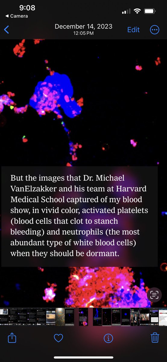 @MarilleyDavid We see major platelet activation in LongCovid - for example see @MBVanElzakker image from @giorgialupi piece below. So what I mean is that the platelets may themselves be infected with SARS-CoV-2, which cld underly at least some of this activation. nytimes.com/interactive/20…