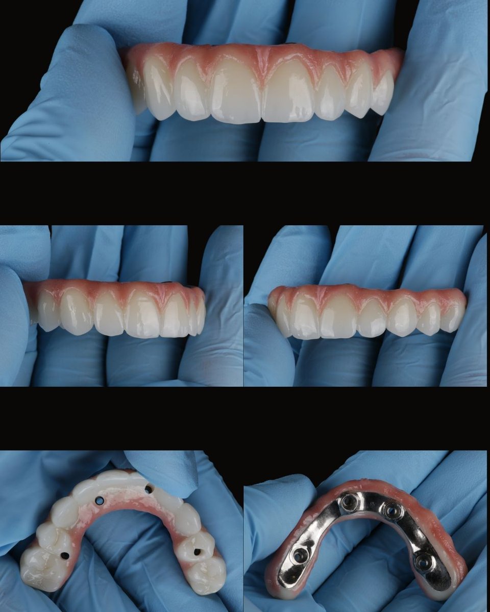 Dentalimplants8's tweet photo. Swipe to see BEFORE ➡️

Patient's Goal. Improve the function of the bite, replace missing teeth, improve the overall shape of teeth, and brighten the smile.

Treatment provided: Upper All on X and fixed implant zirconia and titanium bridge. https://t.co/lCrglTf3Od