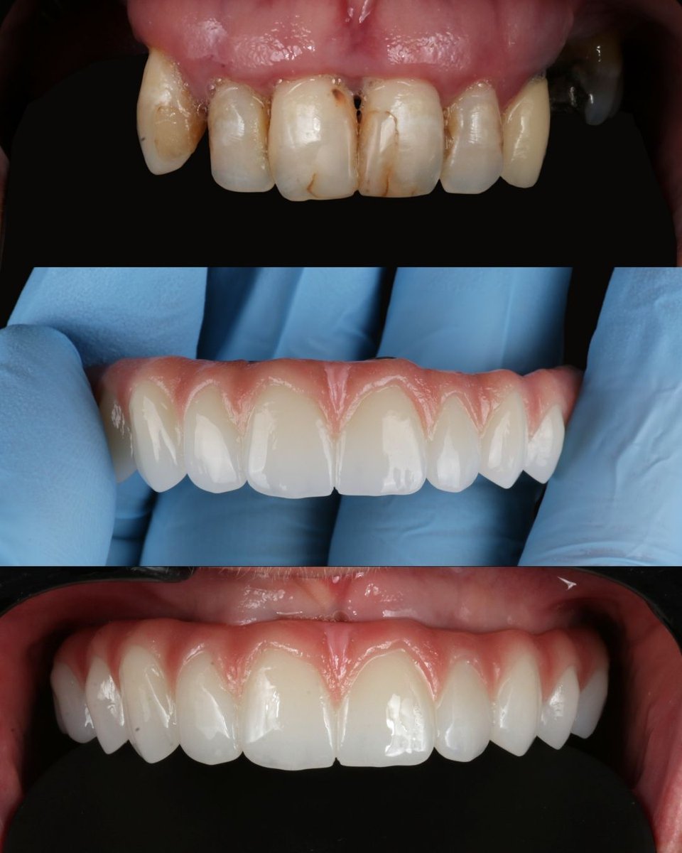 Dentalimplants8's tweet photo. Swipe to see BEFORE ➡️

Patient's Goal. Improve the function of the bite, replace missing teeth, improve the overall shape of teeth, and brighten the smile.

Treatment provided: Upper All on X and fixed implant zirconia and titanium bridge. https://t.co/lCrglTf3Od