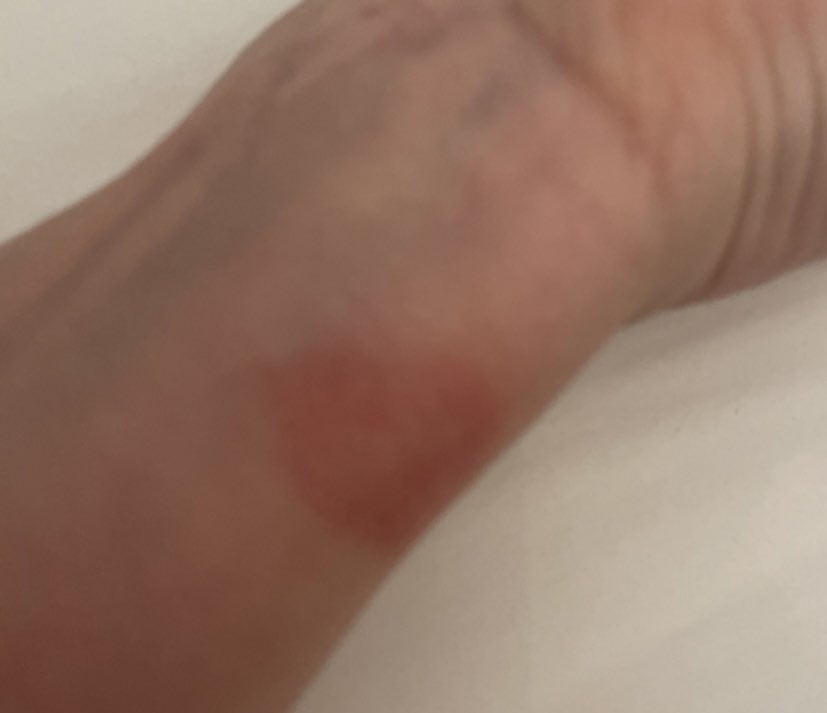 Fibrice's tweet photo. @Apple about time you did something about your watch burning my wrist, numerous emails sent and I’ve spent £35 on calls to your support line! Also looks like it’s not just me @thetimes https://t.co/iqrF41SEPz