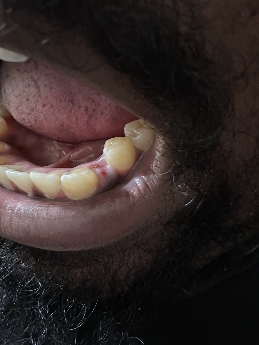KariemCheese's tweet photo. Update: My baby tooth fell out today while I was eating a chopped cheese https://t.co/pI7jgi0u9Y