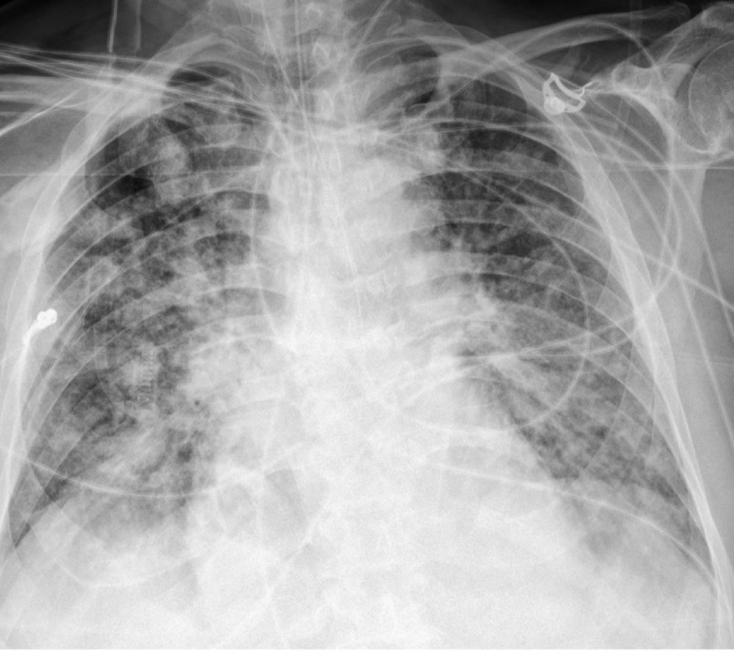 ardila11 (@alvaroardilao) on Twitter photo COVID-19. RX DE TÓRAX CON OPACIDADES PARCHEADAS EN AMBOS CAMPOS BILATERALES COVID-19. RX DE TÓRAX CON OPACIDADES PARCHEADAS EN AMBOS CAMPOS BILATERALES
