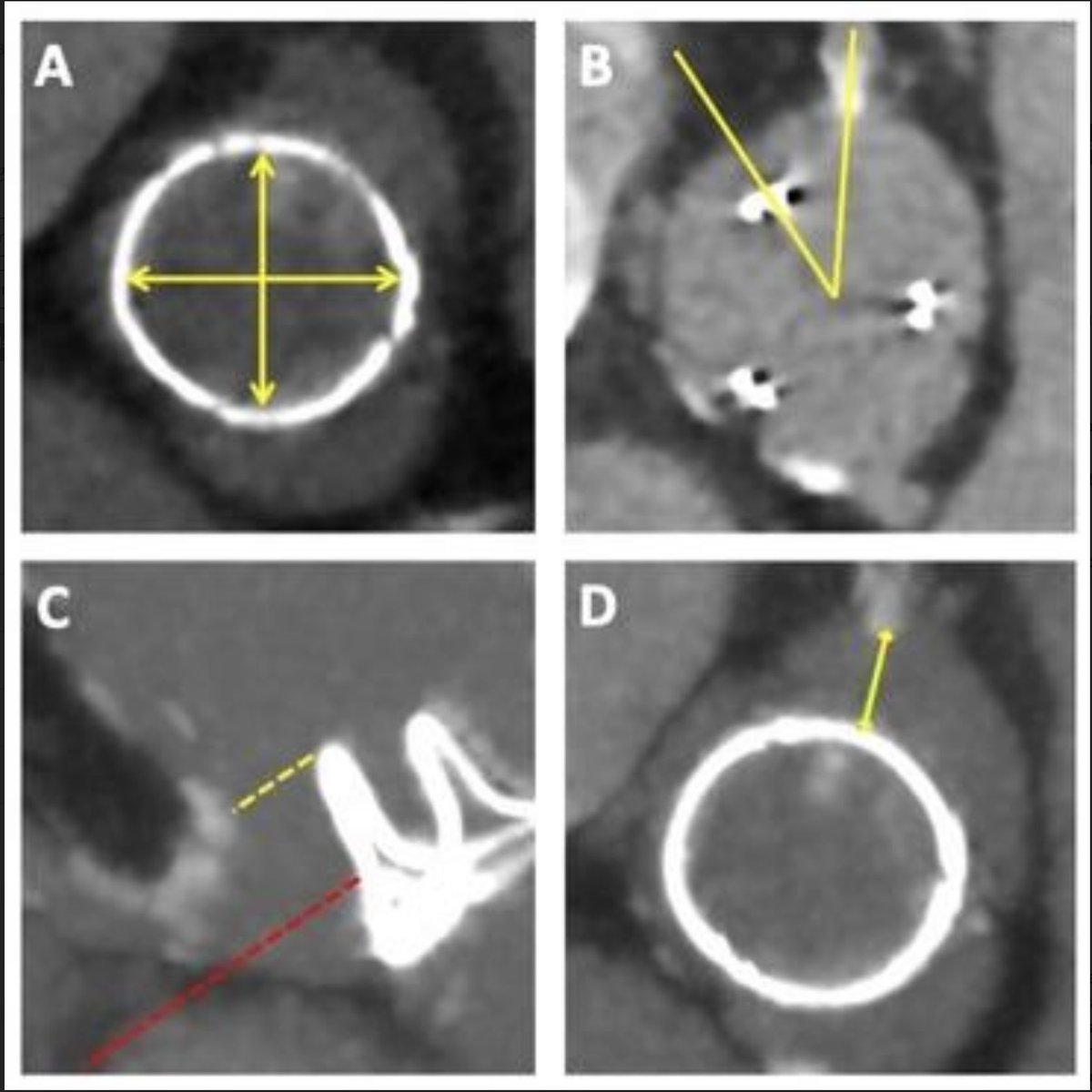 DrOzanDemir's tweet photo. ➡️TAVI to Treat Degenerated Aortic, Mitral and Tricuspid Bioprosthesis

🎯Review of evidence &amp; procedural considerations for using TAVI device in managing degenerated aortic, mitral, or tricuspid prosthesis.

🔗https://t.co/IOShuSUaXt

@PCRonline @BCIS_uk @EssexCTC @ImperialNHS https://t.co/liQMUTm7gK