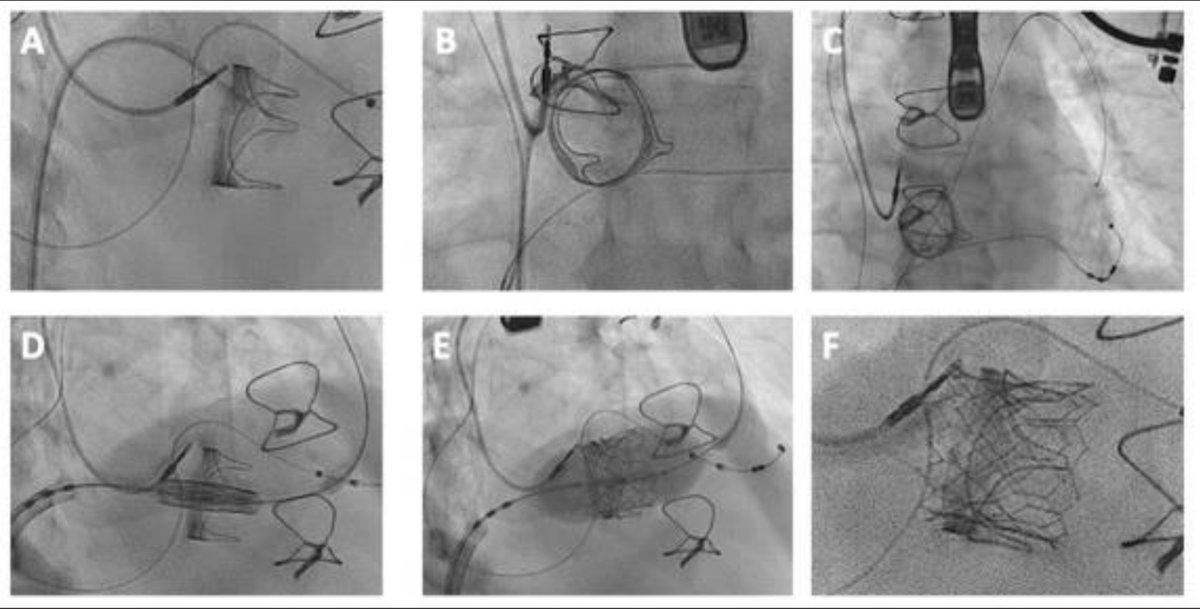 ➡️TAVI to Treat Degenerated Aortic, Mitral and Tricuspid Bioprosthesis 🎯Review of evidence & procedural considerations for using TAVI device in managing degenerated aortic, mitral, or tricuspid prosthesis. 🔗mdpi.com/2077-0383/13/2… @PCRonline @BCIS_uk @EssexCTC @ImperialNHS
