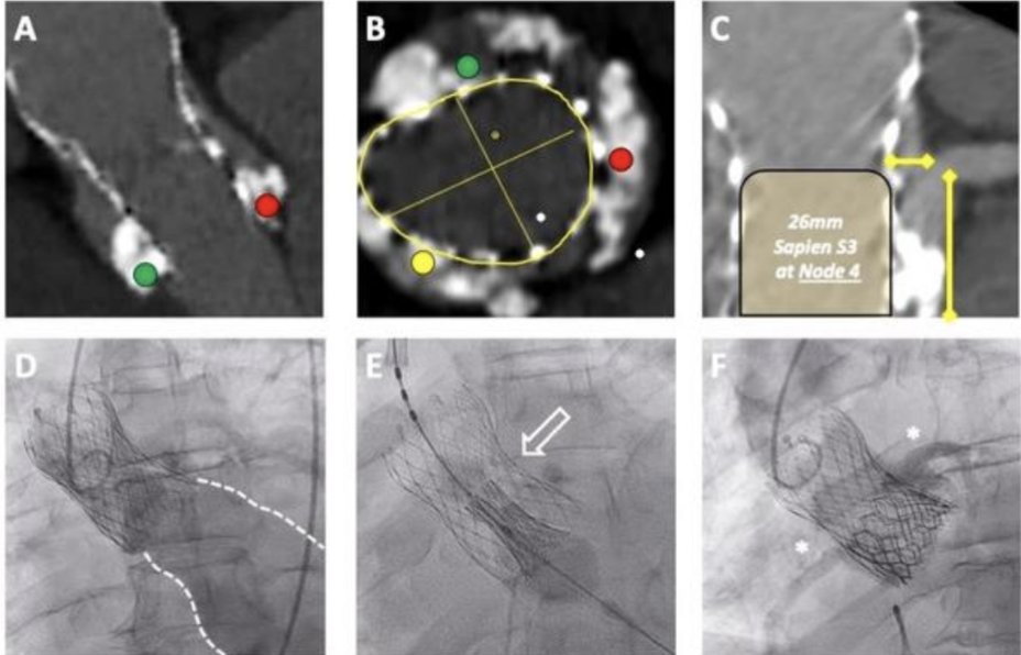 DrOzanDemir's tweet photo. ➡️TAVI to Treat Degenerated Aortic, Mitral and Tricuspid Bioprosthesis

🎯Review of evidence &amp; procedural considerations for using TAVI device in managing degenerated aortic, mitral, or tricuspid prosthesis.

🔗https://t.co/IOShuSUaXt

@PCRonline @BCIS_uk @EssexCTC @ImperialNHS https://t.co/liQMUTm7gK