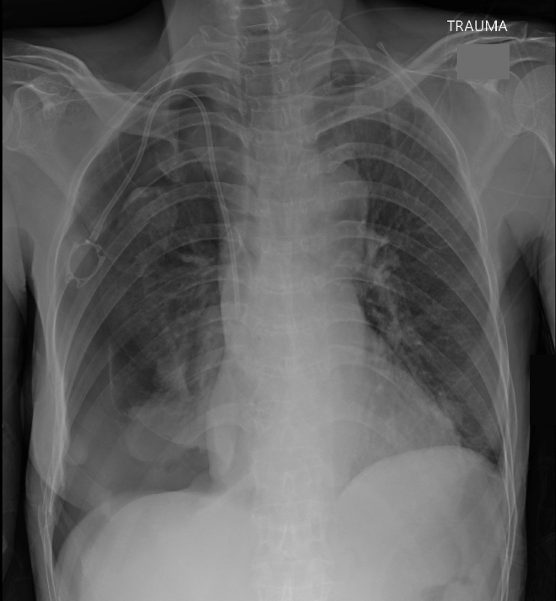 EM_RESUS's tweet photo. Here’s an impressive Chest X-Ray of a 60-year-old lady who slipped and fell in the shower 

What’s the diagnosis? https://t.co/Bm7MwUyI4r