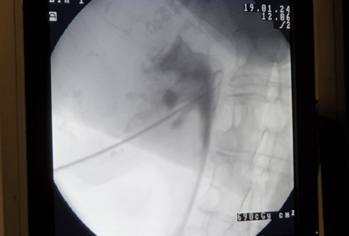 Atif Khan (@atifkhan321) on Twitter photo Great day of learning and discussions at our 2nd Leeds Cadaveric PCNL access & metal ureteric stent course for senior Radiology & Urology trainees. <a href="/CADSIMLeeds/">CADSIM</a> <a href="/shekharbiyani/">Shekhar Biyani</a>,Victor Palit, Stephanie Symons <a href="/DrAarushiG/">Aarushi Gangahar</a> <a href="/Badrakumar/">Chandrasekharan Badrakumar</a>, Bharat Vissamsetti <a href="/BSUroRad/">The British Society of Urogenital Radiology</a> <a href="/BAUSendourology/">BAUS Endourology</a> Great day of learning and discussions at our 2nd Leeds Cadaveric PCNL access & metal ureteric stent course for senior Radiology & Urology trainees. <a href="/CADSIMLeeds/">CADSIM</a> <a href="/shekharbiyani/">Shekhar Biyani</a>,Victor Palit, Stephanie Symons <a href="/DrAarushiG/">Aarushi Gangahar</a> <a href="/Badrakumar/">Chandrasekharan Badrakumar</a>, Bharat Vissamsetti <a href="/BSUroRad/">The British Society of Urogenital Radiology</a> <a href="/BAUSendourology/">BAUS Endourology</a>