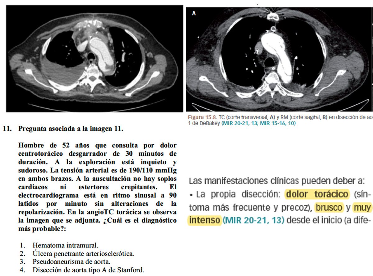Comenzamos análisis del #2MIR24 de cardiología y cirugía CV. Suerte a los premiados! 
#Pregunta11 caso clínico típico de disección de VENA aorta (ese dolor desgarrador, lancinante, transfixiante....) con TAC clásico y del manual
✅ Opción 4
Chupito 🍷 con la primera