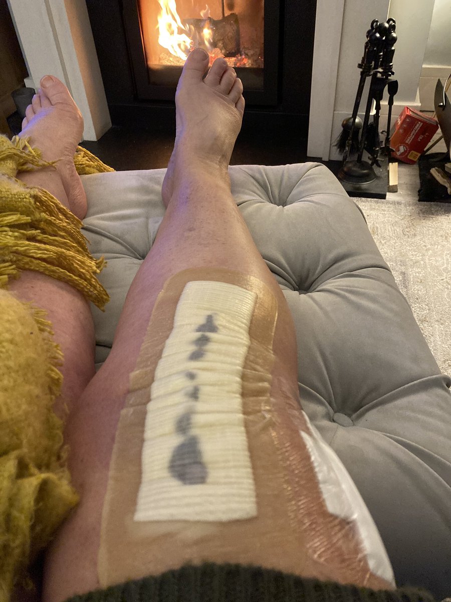 Does it hurt ? Yes it bloody does ! 
#kneereplacement